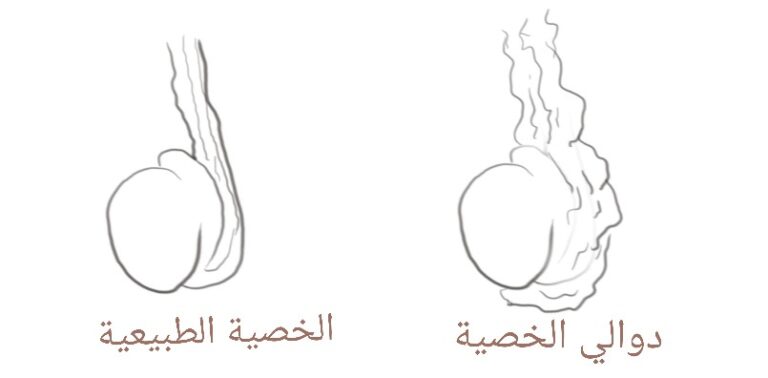 دوالي الخصيتين هي اتساع في أوعية دموية متصلة بالخصيتين، تُدعي أوردة الخصية. الأوردة هي الأوعية الدوية المُصَرِفة للدم بعد استخلاص الأكسجين و العناصر الغذائية و غير ذلك، فيخرج الدم من أي عضو من أعضاء الجسم عبر الأوردة ليتم تصريف النفايات مثل ثاني أوكسيد الكربون و غيره إلي الكبد و الكلي. دوالي الخصية هي اتساع في أوردة الخصية الصاعدة لأعلي، مما يؤدي إلي ركود الدم بها محملاً بالنفايات و رافعاً من درجة الحرارة حول الخصية