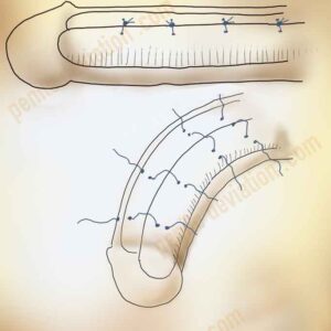 إصلاح تقوس العضو الذكري بتقنية تدوير الجسمين الكهفيين - Corporal Rotation for Penile Curvature