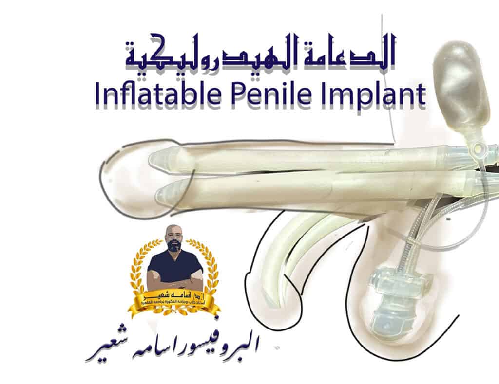 ‏الدعامة الهيدروليكية لعلاج ضعف الانتصاب Inflatable penile Implant for Erectile Dysfunction - ED