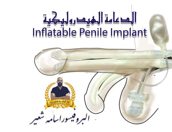 الدعامة الهيدروليكية لعلاج ضعف الانتصاب Inflatable penile Implant for Erectile Dysfunction - ED