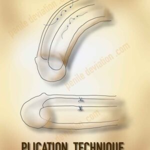 إصلاح تقوس العضو الذكري بتقنية الشد - Plication for Penile Curvature
