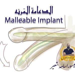 ‏الدعامة المَرِنه Malleable Implant