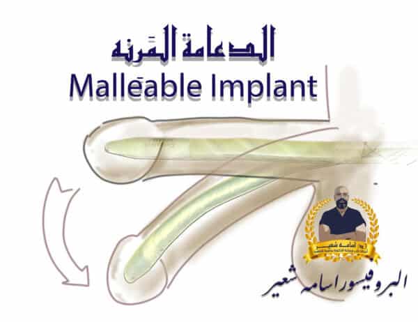 الدعامة المَرِنه Malleable Implant