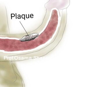 Peyronie's plaque surgery جراحة بيروني