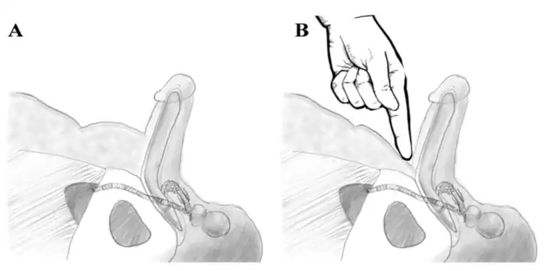‏تقنية شعير دعامة العضو الذكري مع إطالة القضيب