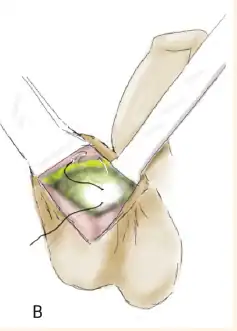 دعامة العضو الذكري مع إطالة القضيب بشد دهون العانة 2