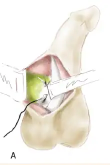 دعامة العضو الذكري مع إطالة القضيب بشد دهون العانة 1