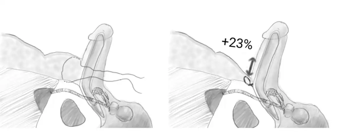 دعامة ‏الانتصاب مع الإطالة