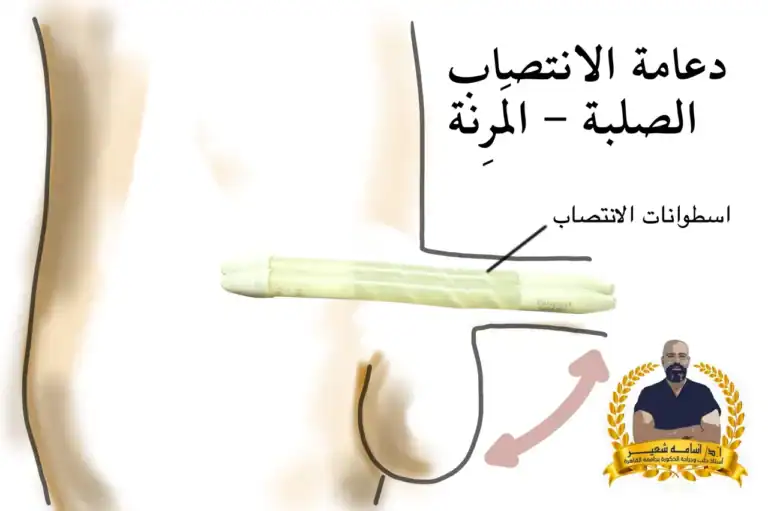 ‏ ‏أنواع ‏دعامة الانتصاب | الدعامة الصلبة المرنة