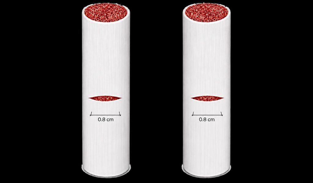 Shaeer's Transverse Corporotomies for inflatable penile prosthesis implantation, less than 1cm long