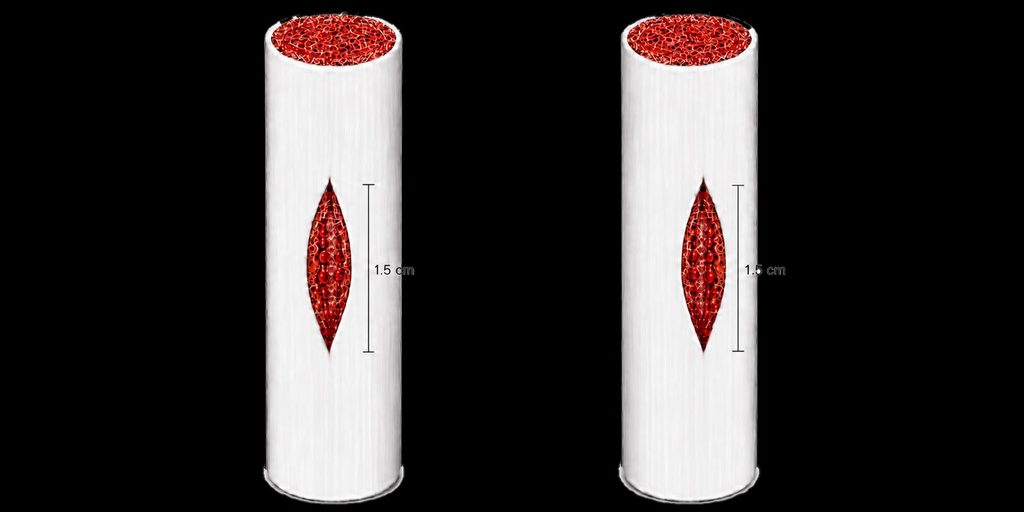 Traditional vertical corporotomies are 1.5-2 cm long, through which the inflatable penile prostehsis is implanted